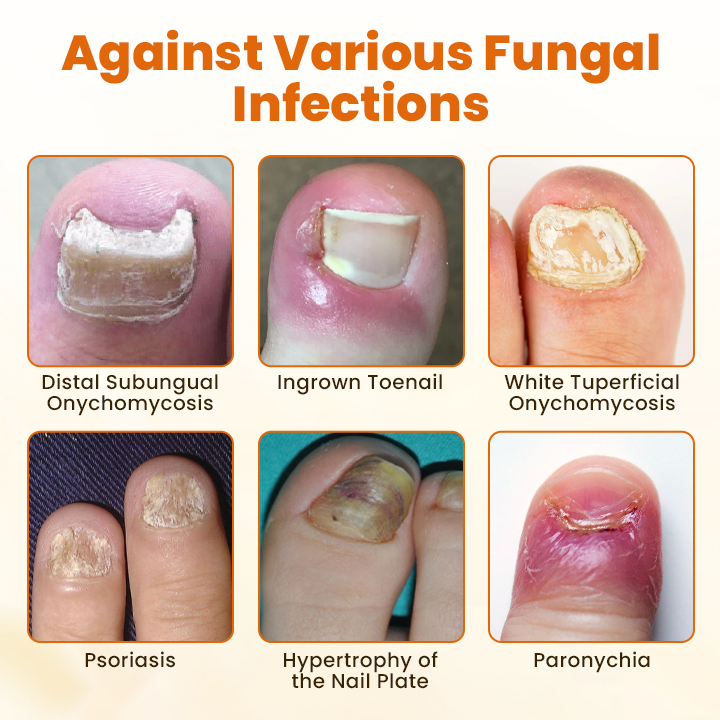 Timilk® FungiBee Advanced Nail Repair Spray