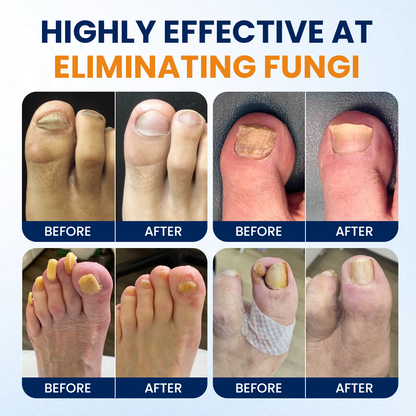 Timilk® Nail fungus relief spray