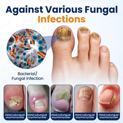 Timilk® Nail fungus relief spray