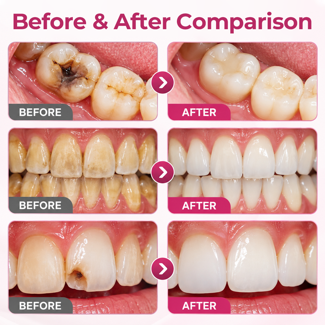 Timilk® DenPerm Cavity-Repair Natural Enamel Filling Gel ❤️
