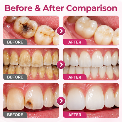 Timilk® DenPerm Cavity-Repair Natural Enamel Filling Gel ❤️