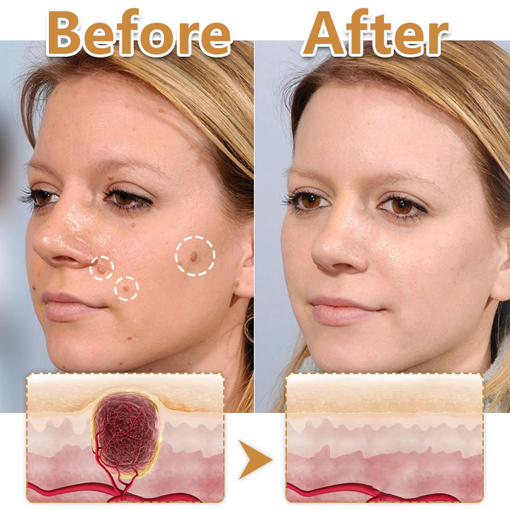 Biancat® BeeVenom Wart Drop Serum