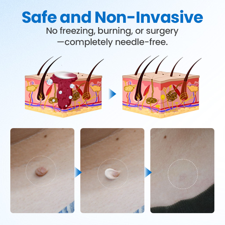 Timilk® TagGone Wart Removal Cream 🎁