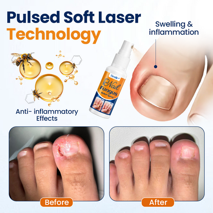Timilk® Nail fungus relief spray